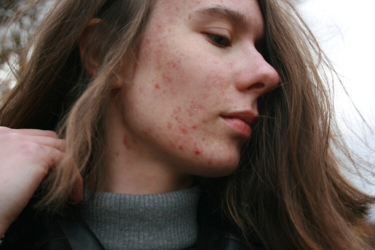 How to Tell if Acne is Hormonal or Bacterial
