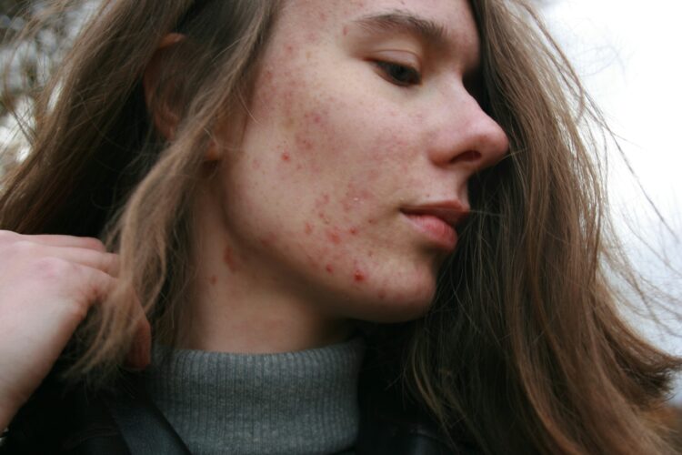 Person with acne on their cheek | So, Can Acne Be Caused By Lack of Sleep?