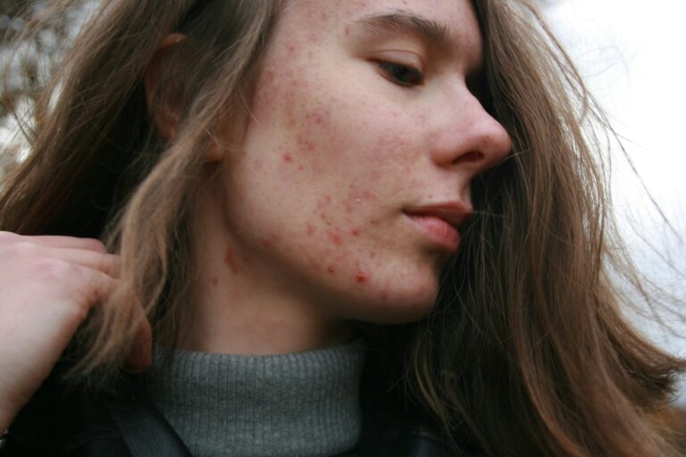 So, Can Acne Be Caused By Lack of Sleep?